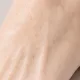 Freckles, Moles & Birthmarks — Light