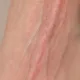 Veins & Natural Skin Colouring — Blue Tint
