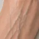 Veins & Natural Skin Colouring — Medium