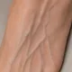 Veins & Natural Skin Colouring — Prominent