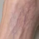 Veins & Natural Skin Colouring — Red